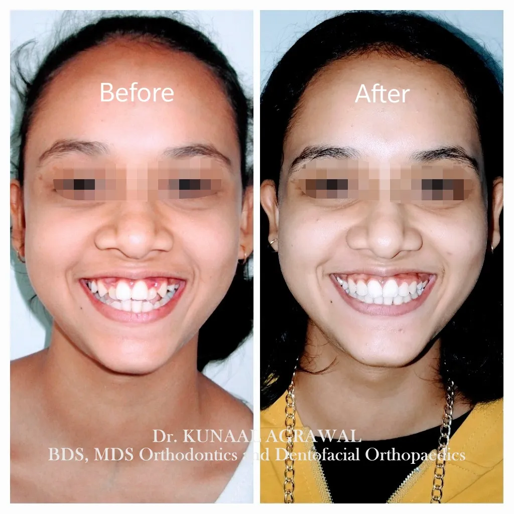 braces before and after bhopal 3